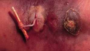 Co potřebujete vědět o subkutánních parazitech